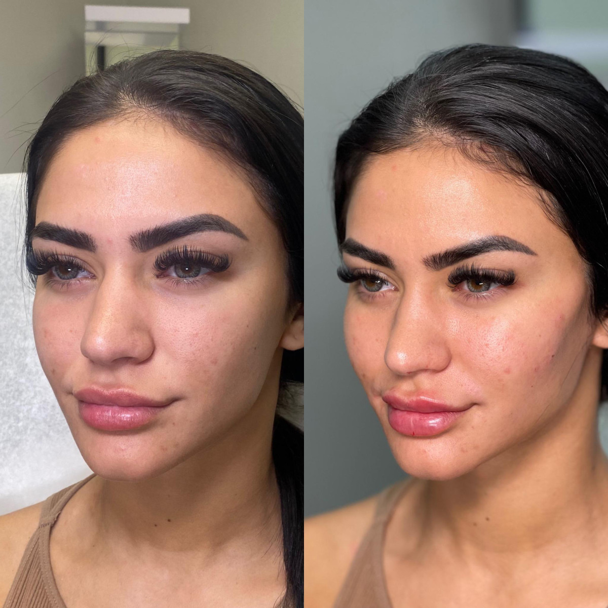 Dermal Fillers in Clearwater, FL: Unlock Your Youthful Radiance